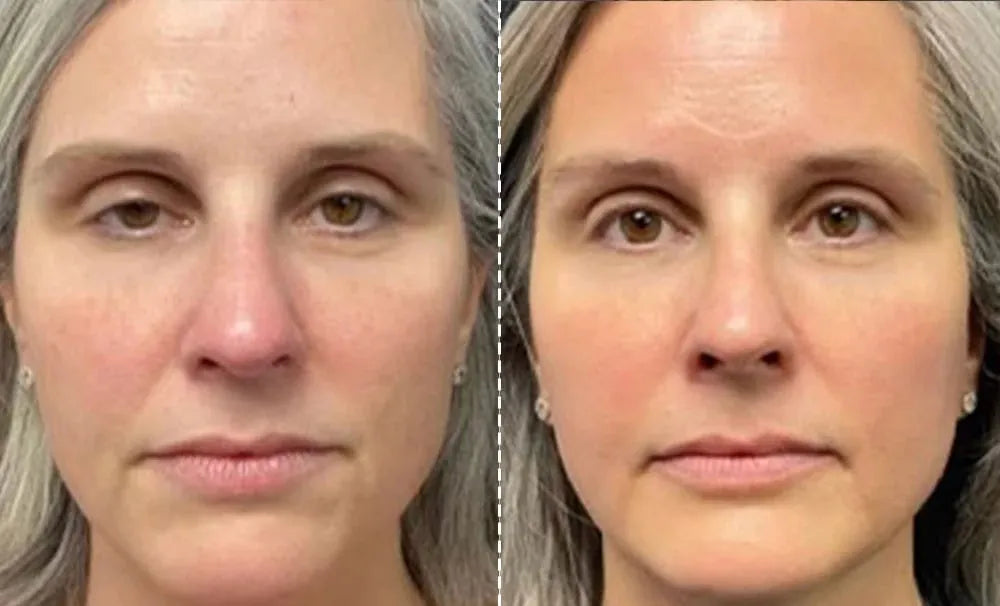 EMS Facial Mask