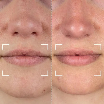 Lip Light Therapy and Teeth Whitening Device