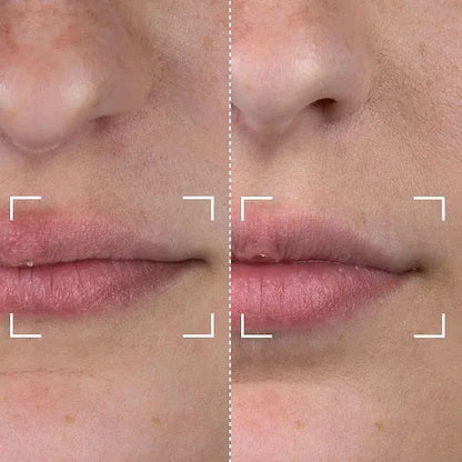 Lip Light Therapy and Teeth Whitening Device